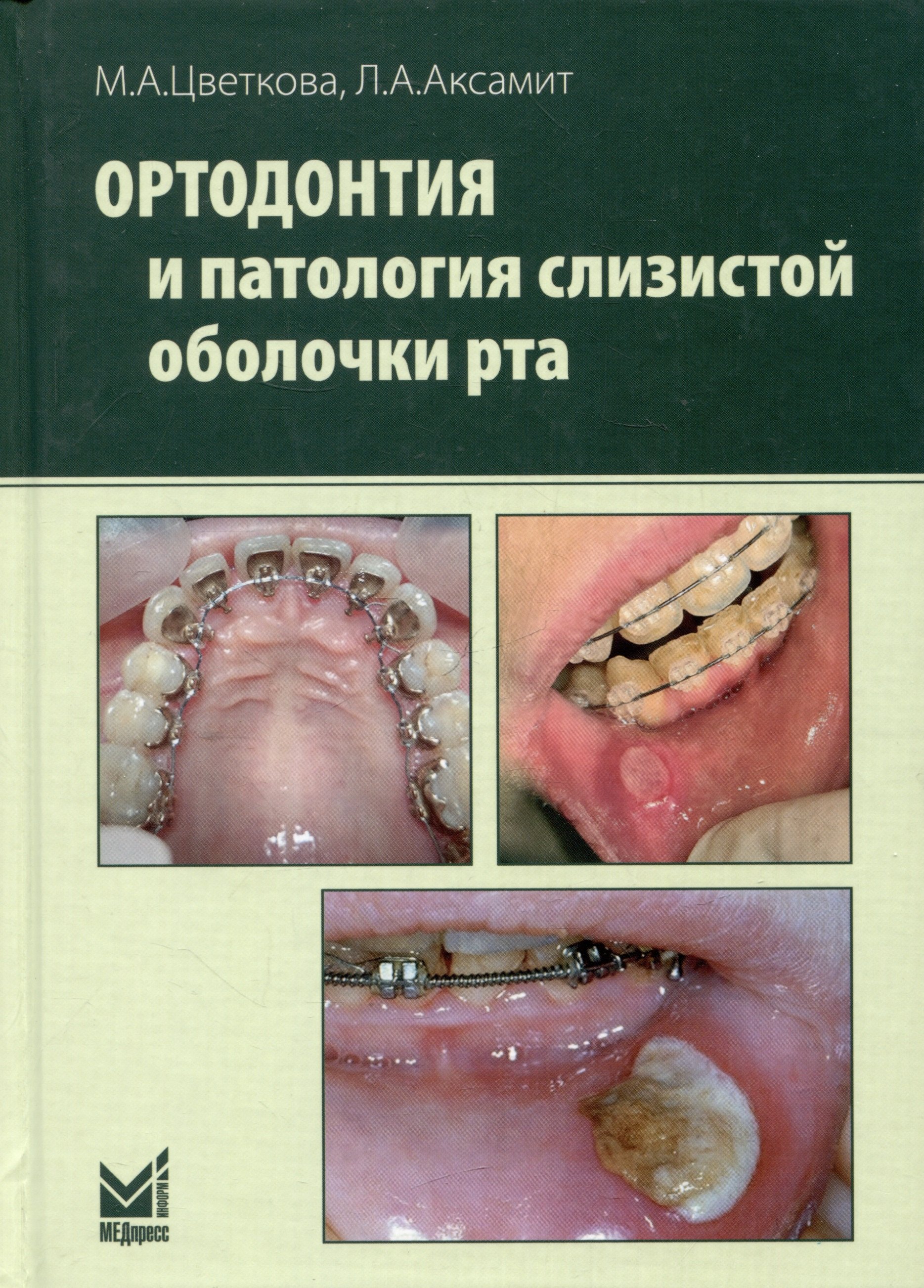 Анатольевна Аксамит Людмила: Ортодонтия и патология слизистой оболочки рта