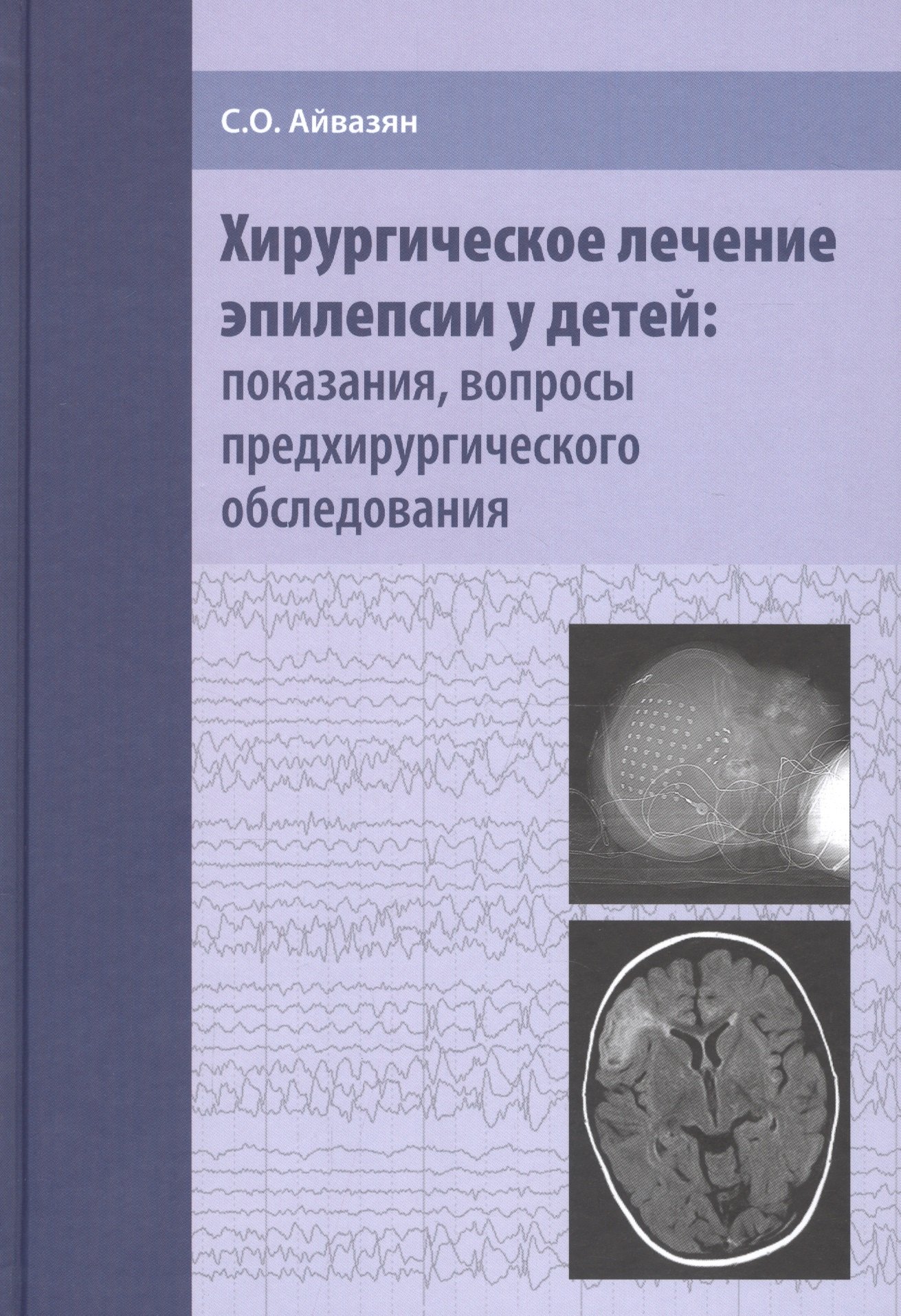 Оганесович Айвазян Сергей: Хирургическое лечение эпилепсии у детей: показания, вопросы предхирургического обследования