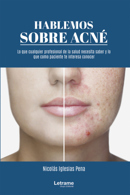 Iglesias Nicolás Pena: Hablemos sobre acné: 01 (Manual)