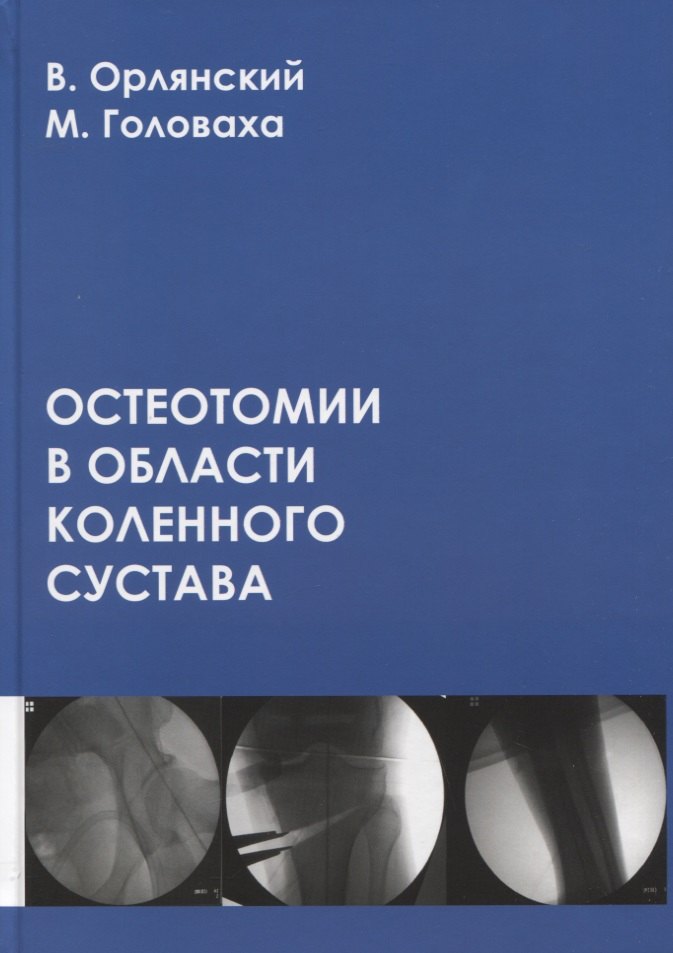 Вениамин Орлянский: Остеотомии в области коленного сустава