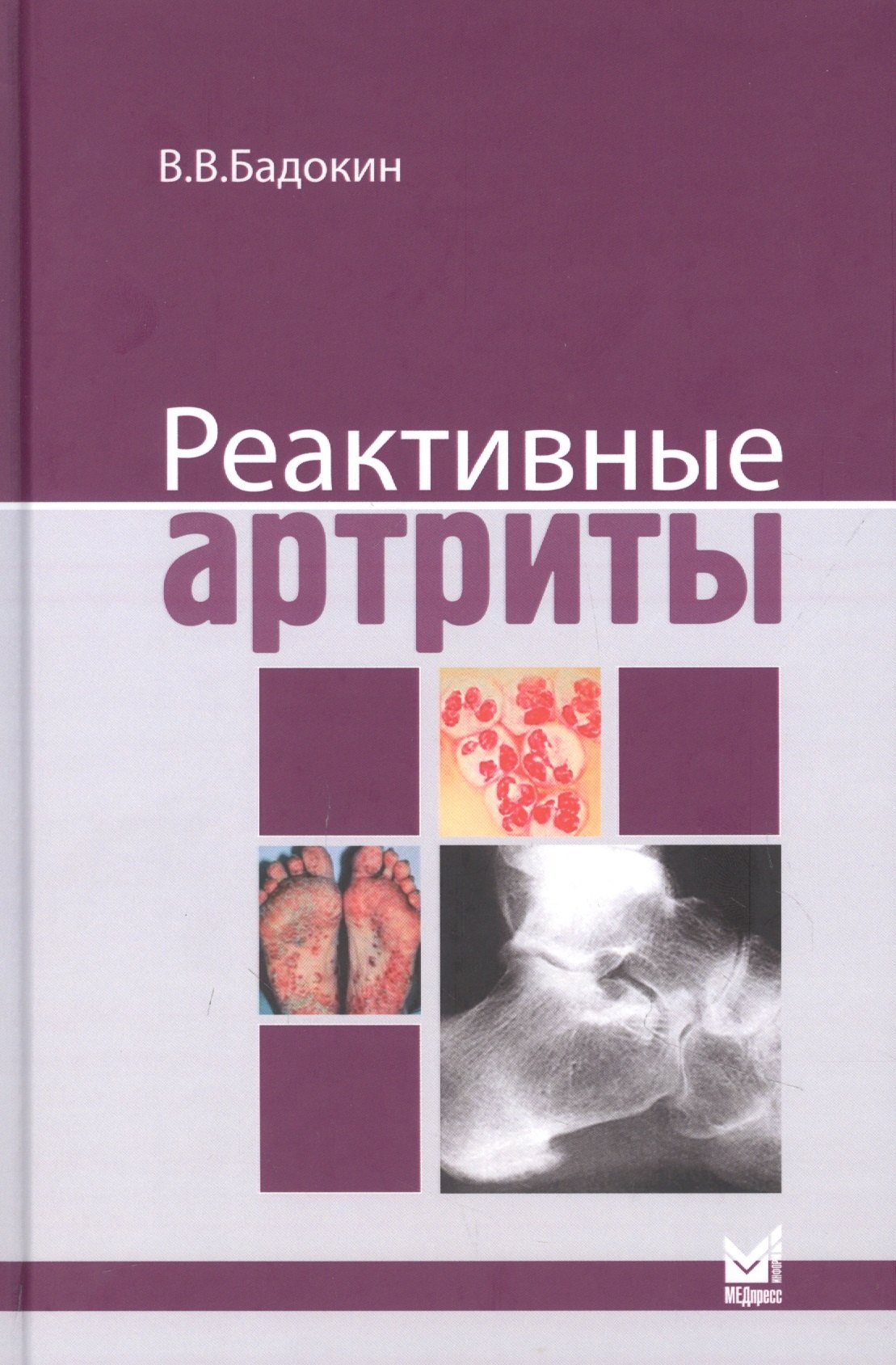 Васильевич Бадокин Владимир: Реактивные артриты