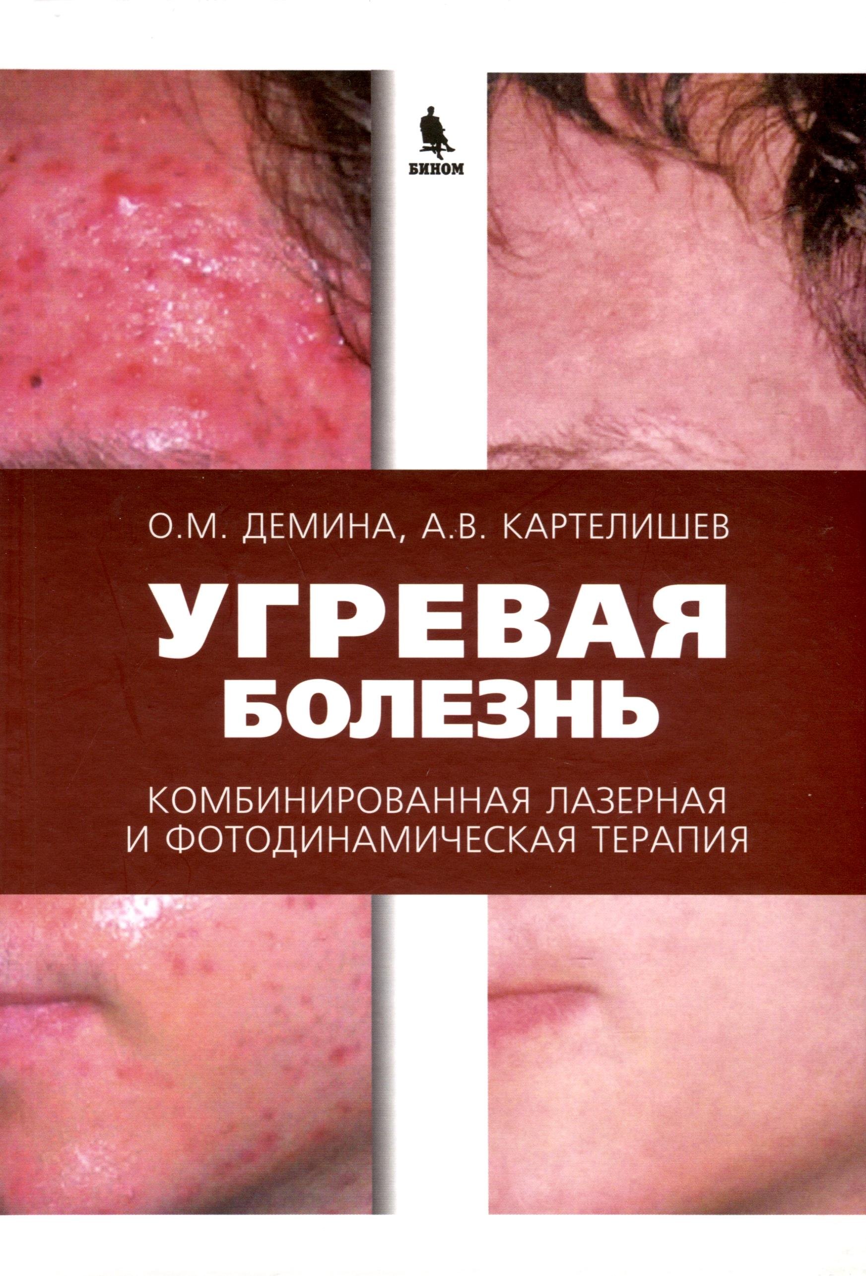 Васильевич Картелишев Анатолий: Угревая болезнь. Комбинированная лазерная и фотодинамическая терапия
