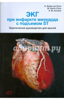 Байдес де Луна: ЭКГ при инфаркте миокарда с подъемом ST